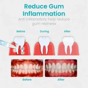 NESLEMY™ Gum Shield Therapy Gel 2025