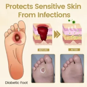 Timilk® Diabetic Foot Healing Spray – Bee Venom Infused